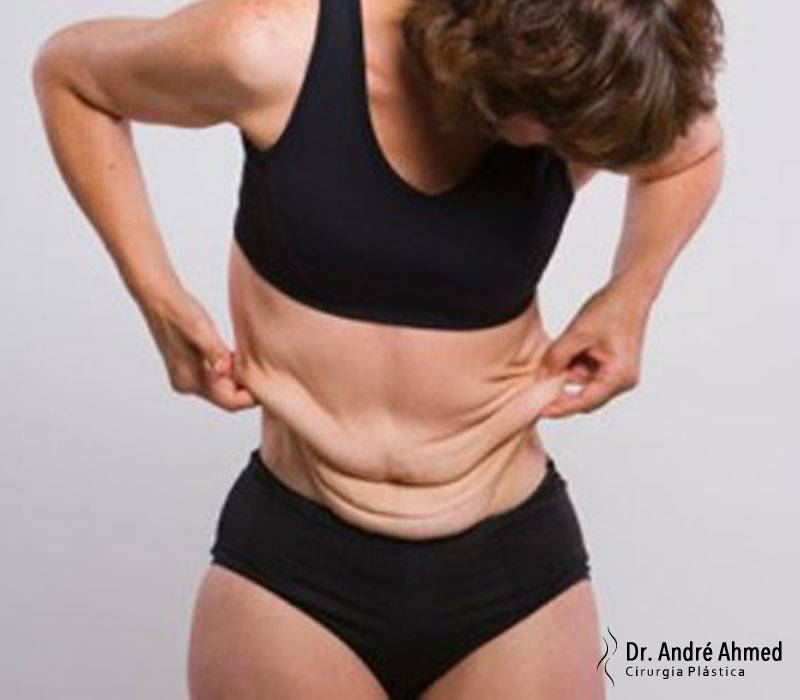 Abdominoplastia