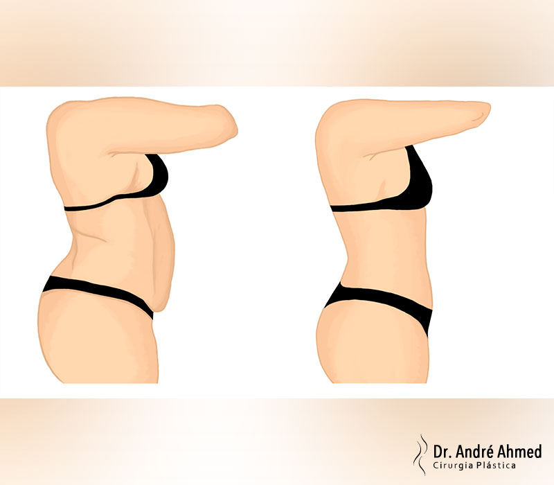 Abdominoplastia