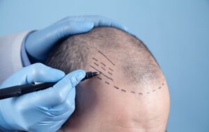 Tecnologia visa mais naturalidade em transplante capilares