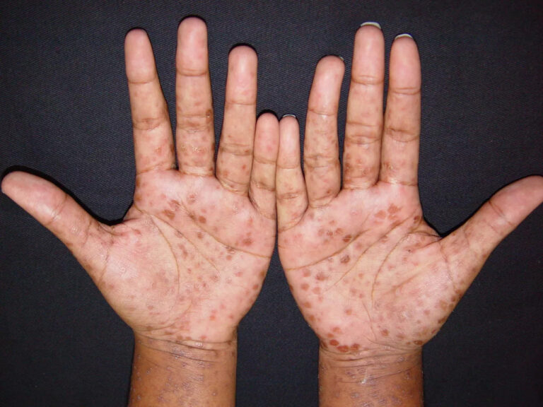 Casos de sífilis crescem em BH: mais de 4 mil pessoas já foram diagnosticadas neste ano Casos de sífilis crescem em BH: mais de 4 mil pessoas já foram diagnosticadas neste ano - Foto: Reprodução