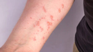 Minas Gerais registra 13 casos confirmados de mpox - Foto: Reprodução