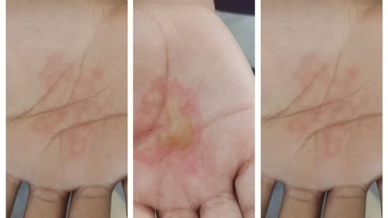 Homem é preso suspeito de queimar mãos dos três filhos com canjiquinha fervendo em Nova Lima Homem é preso suspeito de queimar mãos dos três filhos com canjiquinha fervendo em Nova Lima - Foto: Reprodução
