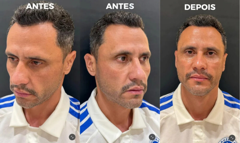Cleitinho faz procedimentos estéticos no rosto menos de 24 horas após ser eleito governador de MG - Foto: Reprodução